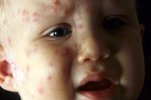 Управление охраны здоровья ОГА: В Тернопольской области вспышка энтеровирусной инфекции среди детей